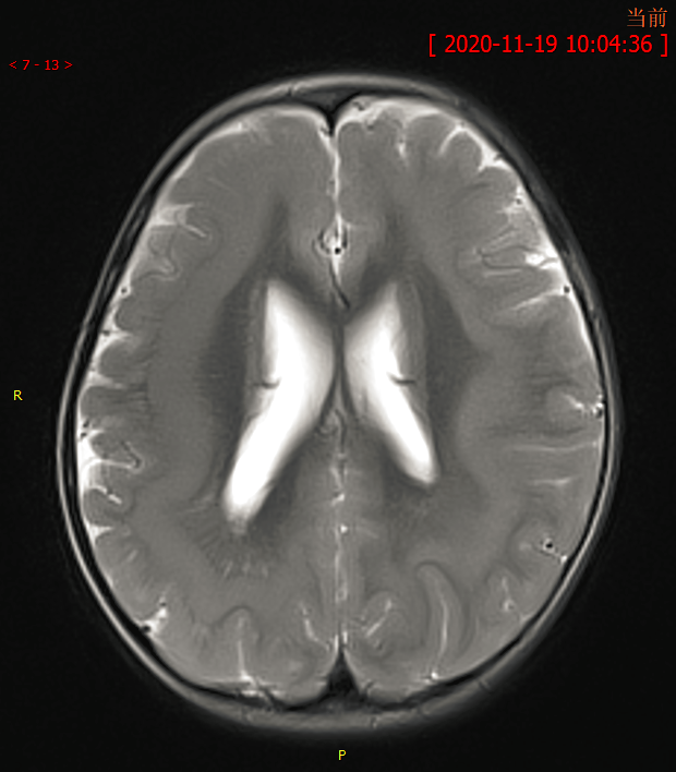 八个病例带你看懂脑灰质异位的三种类型-3