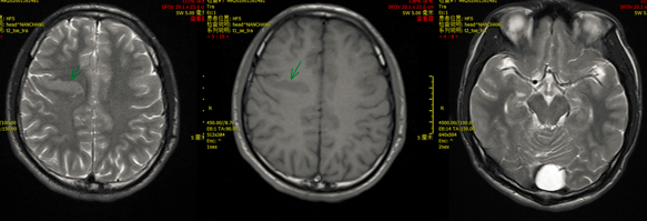 八个病例带你看懂脑灰质异位的三种类型-8