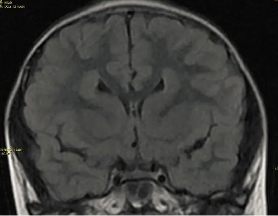 八个病例带你看懂脑灰质异位的三种类型-6