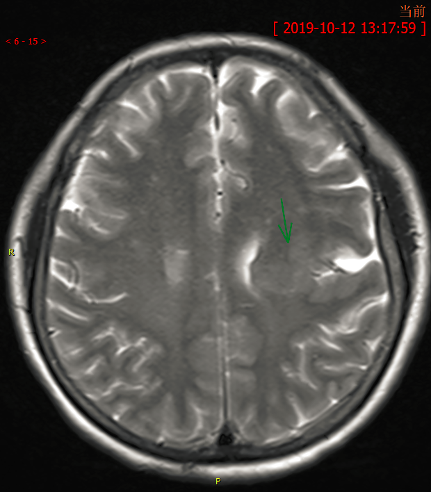八个病例带你看懂脑灰质异位的三种类型-2