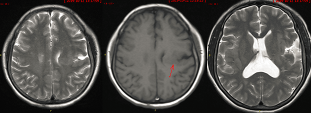 八个病例带你看懂脑灰质异位的三种类型-9