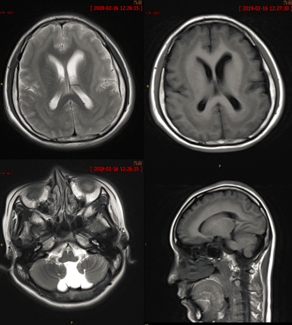 八个病例带你看懂脑灰质异位的三种类型-12