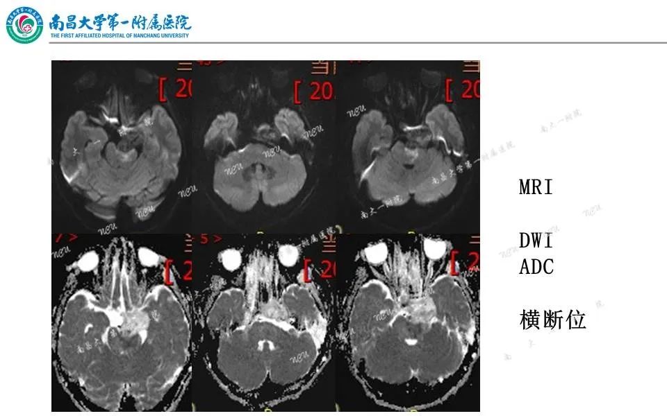 【PPT】颅底肿瘤的影像诊断思路-4