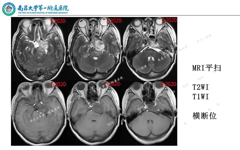 【PPT】颅底肿瘤的影像诊断思路-3