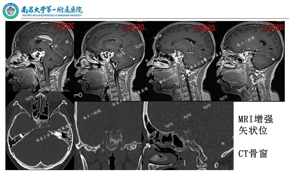 【PPT】颅底肿瘤的影像诊断思路-6
