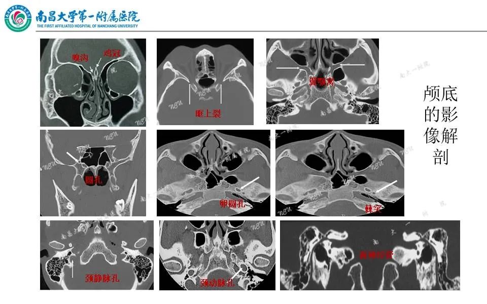 【PPT】颅底肿瘤的影像诊断思路-15