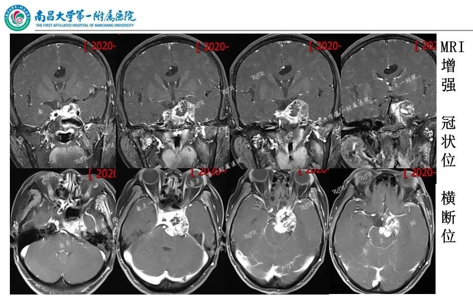 【PPT】颅底肿瘤的影像诊断思路-5