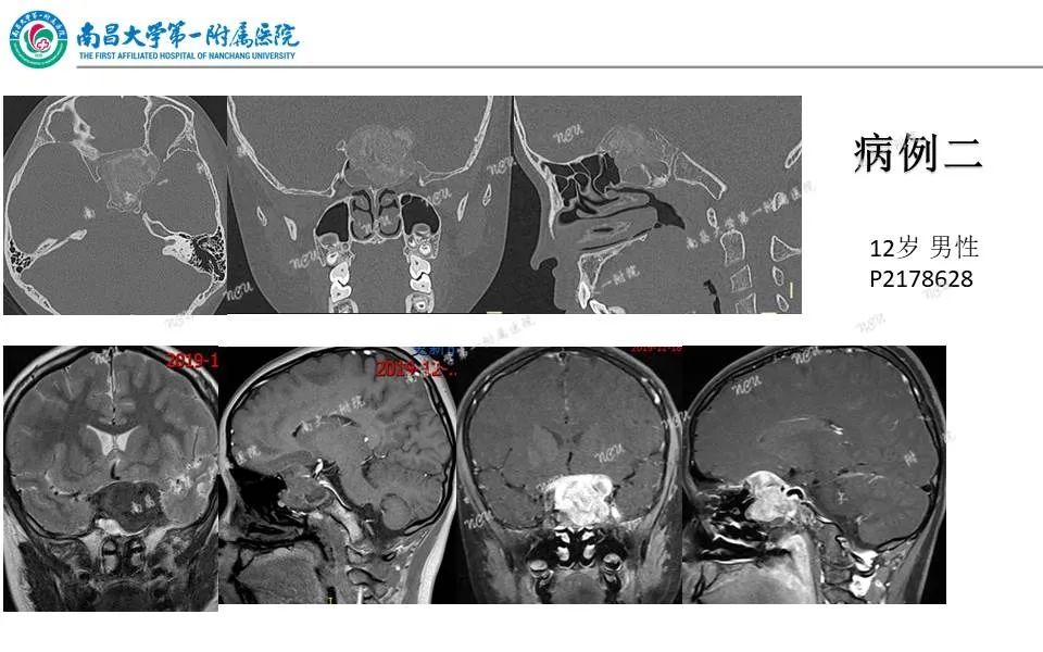 【PPT】颅底肿瘤的影像诊断思路-25