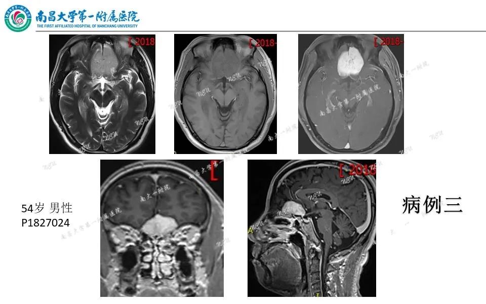 【PPT】颅底肿瘤的影像诊断思路-27