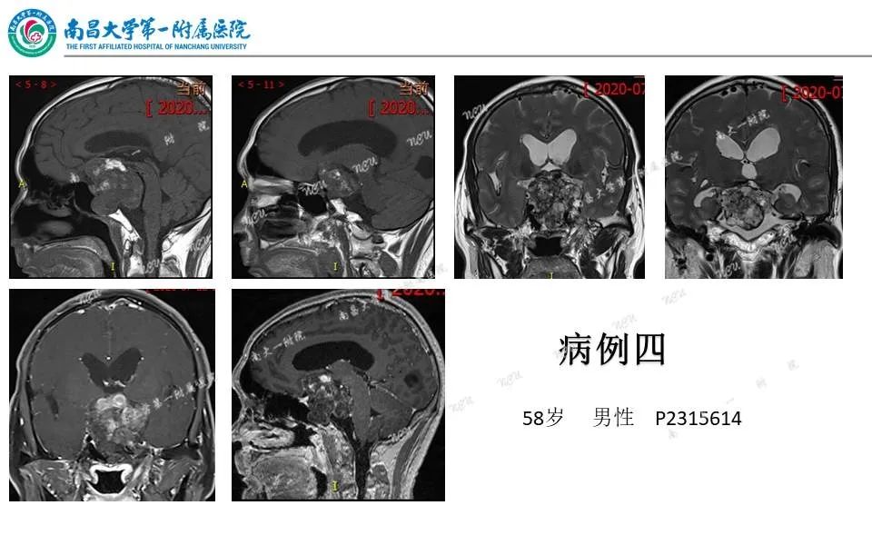 【PPT】颅底肿瘤的影像诊断思路-29