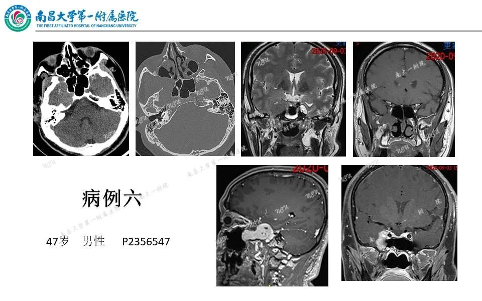 【PPT】颅底肿瘤的影像诊断思路-33