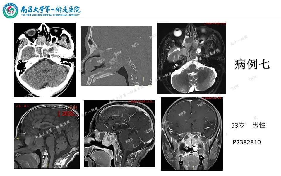 【PPT】颅底肿瘤的影像诊断思路-35