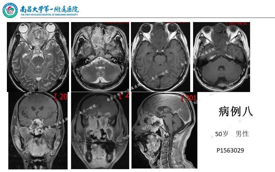 【PPT】颅底肿瘤的影像诊断思路-37