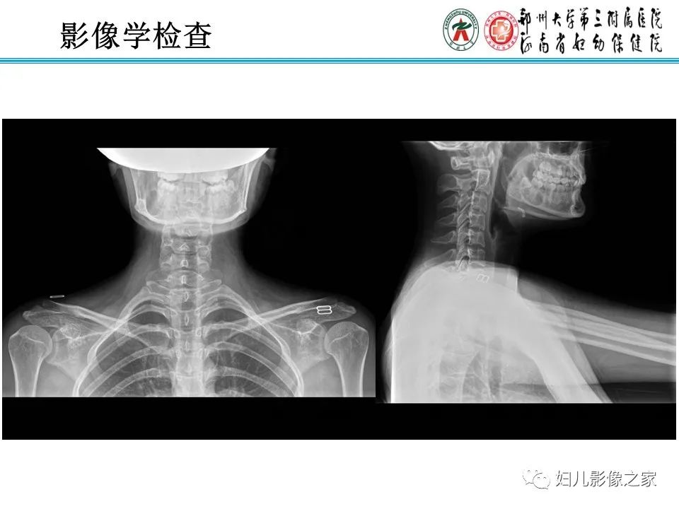 【病例】牙源性角化囊性瘤1例影像诊断-3