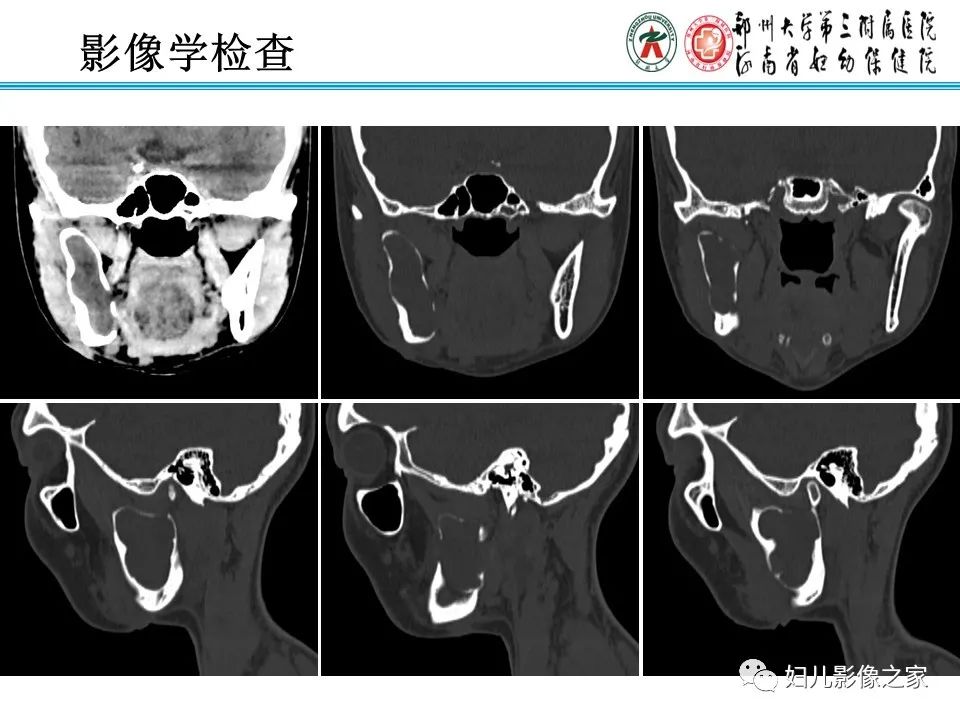 【病例】牙源性角化囊性瘤1例影像诊断-4