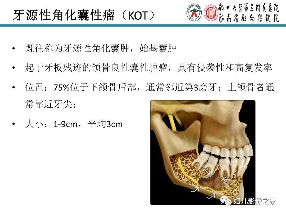 【病例】牙源性角化囊性瘤1例影像诊断-9