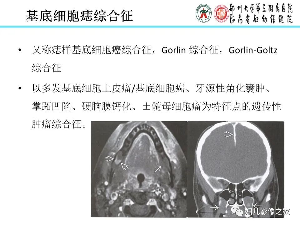 【病例】牙源性角化囊性瘤1例影像诊断-11