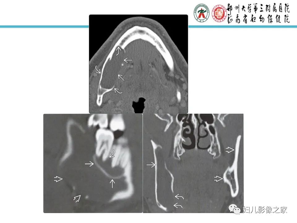 【病例】牙源性角化囊性瘤1例影像诊断-16