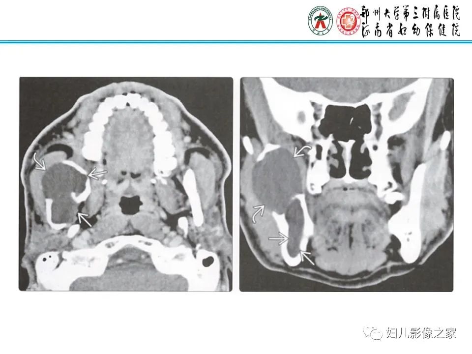 【病例】牙源性角化囊性瘤1例影像诊断-18