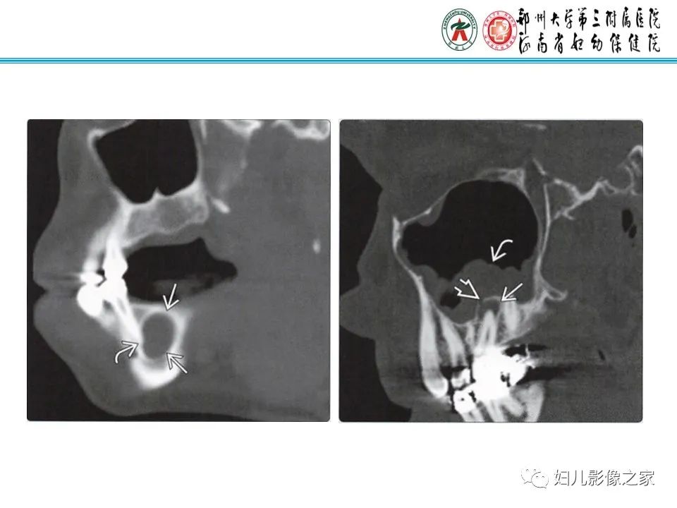 【病例】牙源性角化囊性瘤1例影像诊断-22