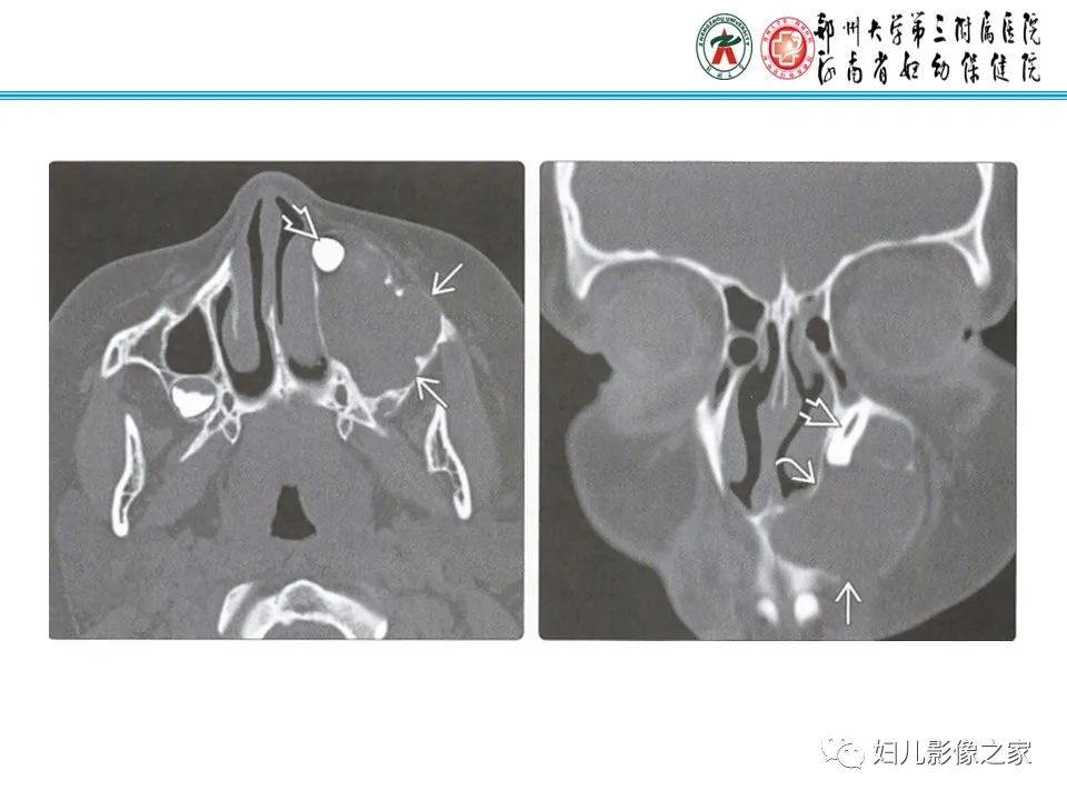 【病例】牙源性角化囊性瘤1例影像诊断-17