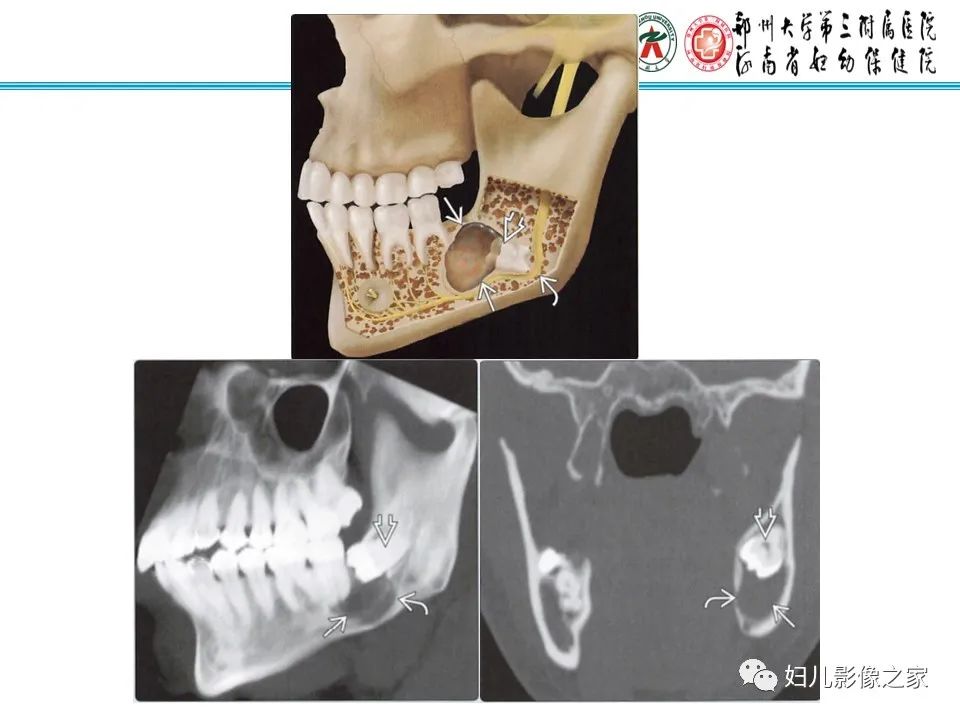【病例】牙源性角化囊性瘤1例影像诊断-24