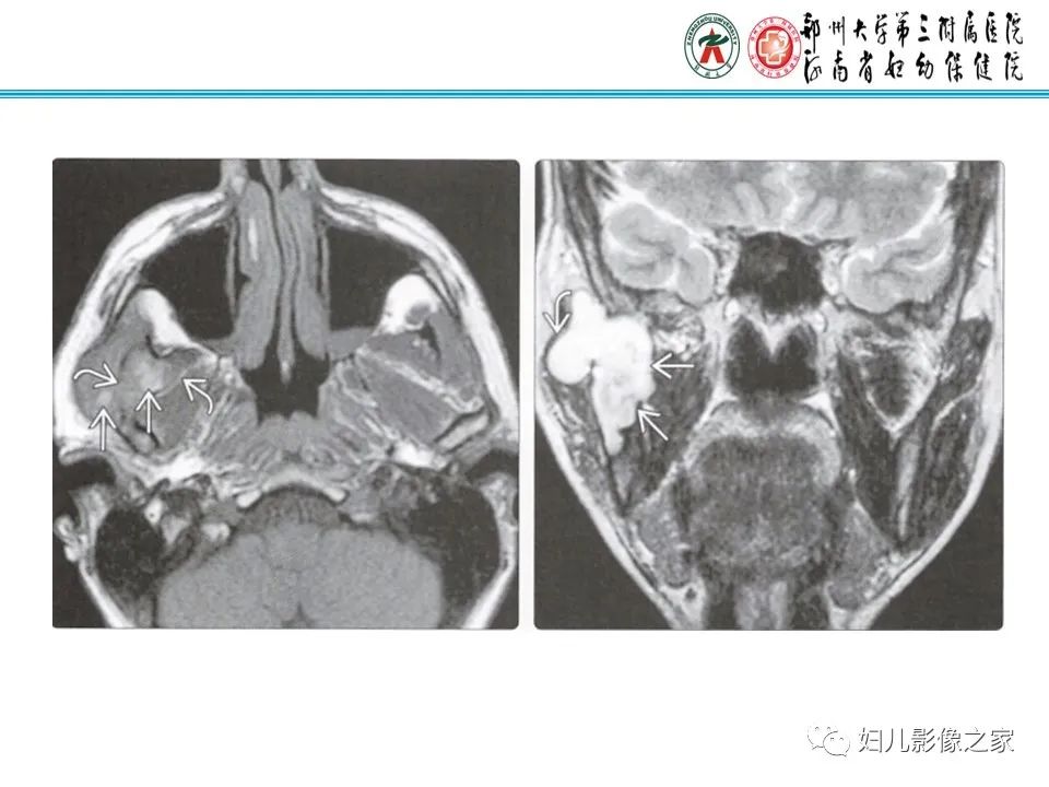 【病例】牙源性角化囊性瘤1例影像诊断-20