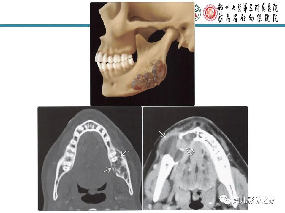 【病例】牙源性角化囊性瘤1例影像诊断-26