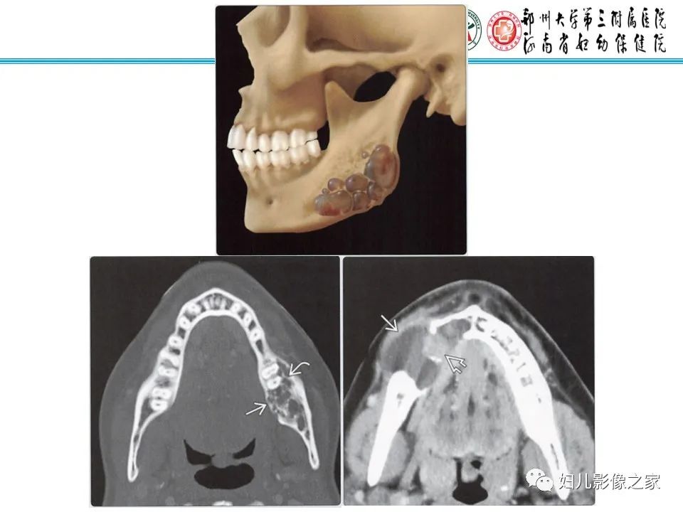 【病例】牙源性角化囊性瘤1例影像诊断-26
