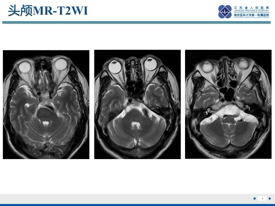 【PPT】椎基底动脉延长扩张症-6