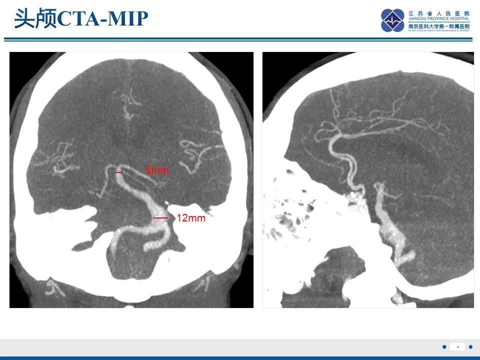 【PPT】椎基底动脉延长扩张症-4