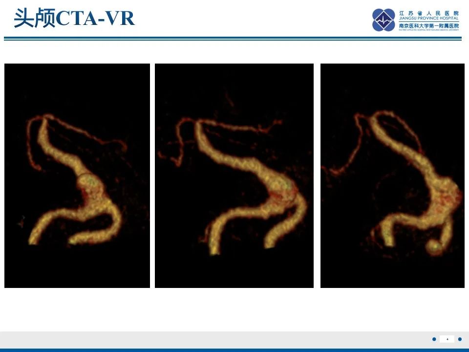 【PPT】椎基底动脉延长扩张症-5