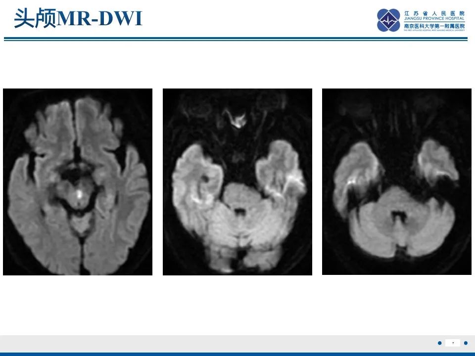 【PPT】椎基底动脉延长扩张症-8