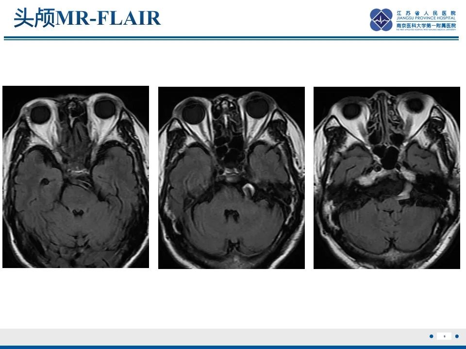 【PPT】椎基底动脉延长扩张症-7