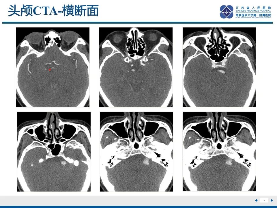 【PPT】椎基底动脉延长扩张症-3