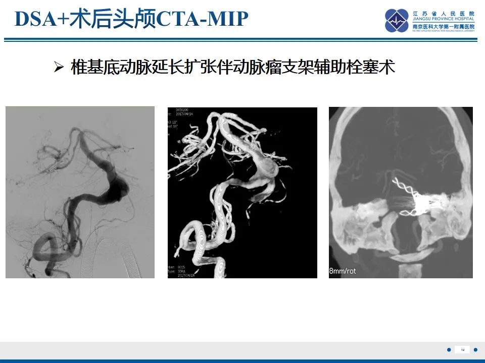 【PPT】椎基底动脉延长扩张症-13