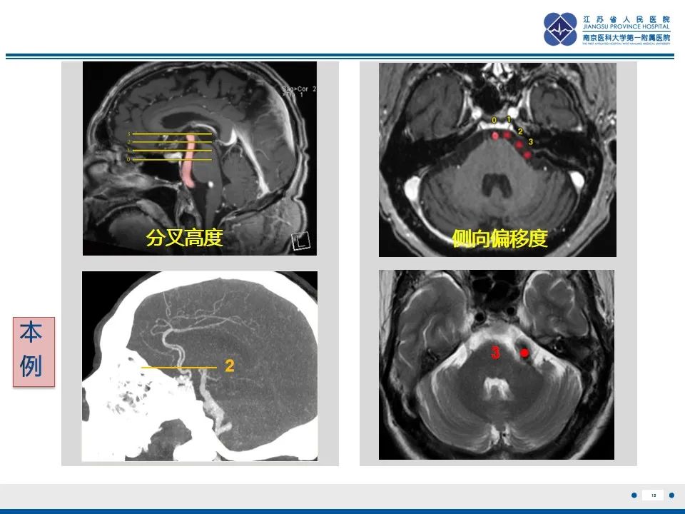 【PPT】椎基底动脉延长扩张症-16