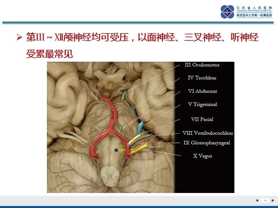 【PPT】椎基底动脉延长扩张症-20