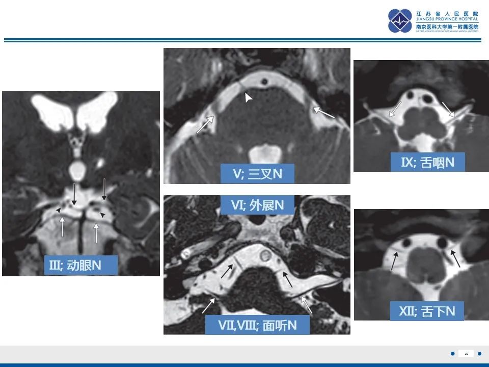 【PPT】椎基底动脉延长扩张症-21