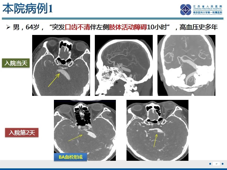 【PPT】椎基底动脉延长扩张症-28