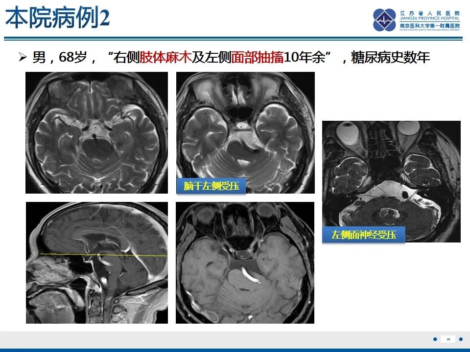 【PPT】椎基底动脉延长扩张症-29