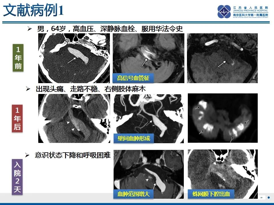 【PPT】椎基底动脉延长扩张症-30