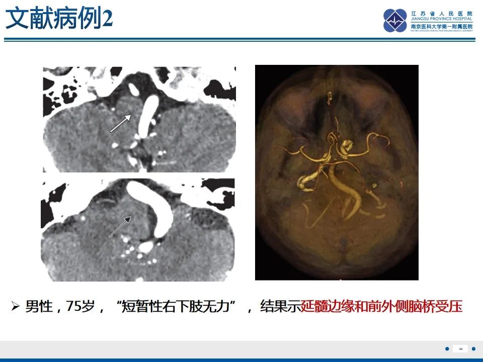 【PPT】椎基底动脉延长扩张症-31
