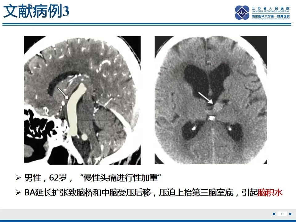 【PPT】椎基底动脉延长扩张症-32