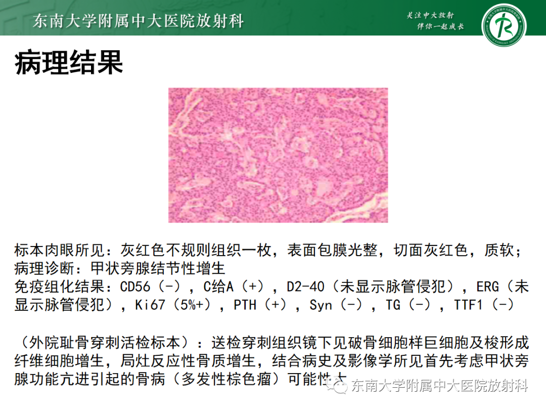 【PPT】原发性甲状旁腺功能亢进-6