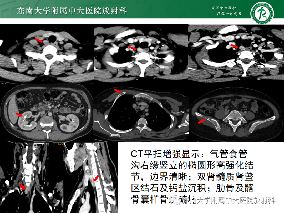 【PPT】原发性甲状旁腺功能亢进-4