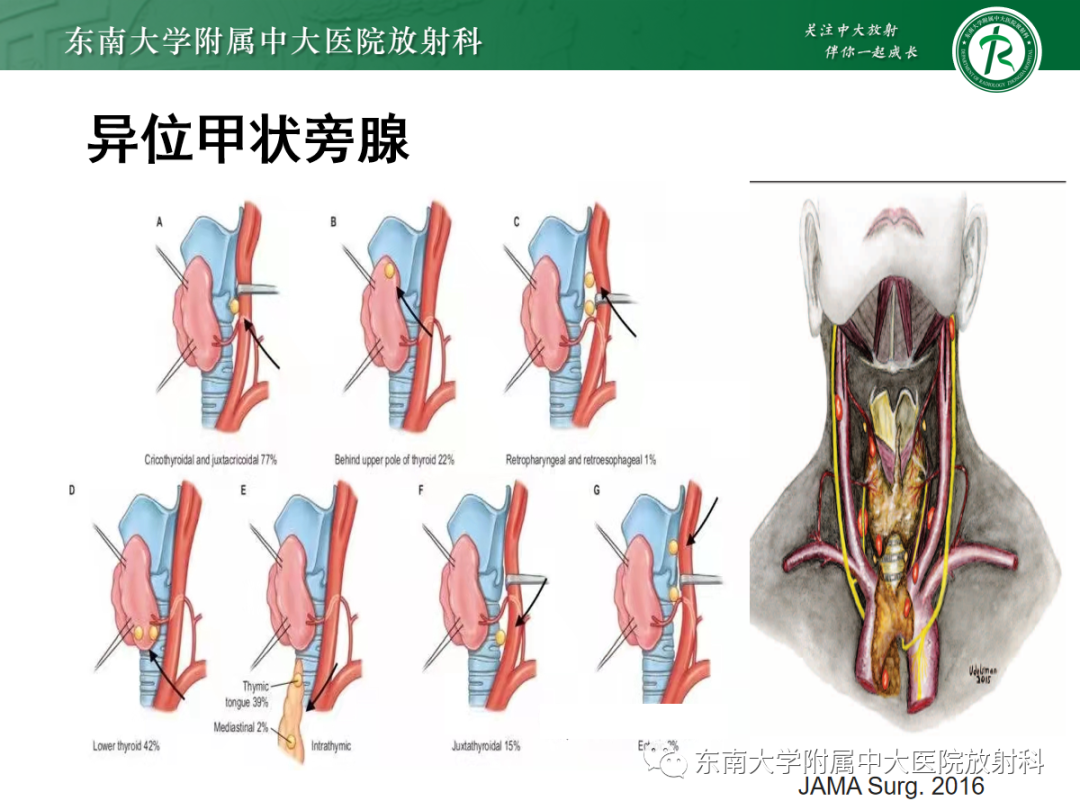 【PPT】原发性甲状旁腺功能亢进-11