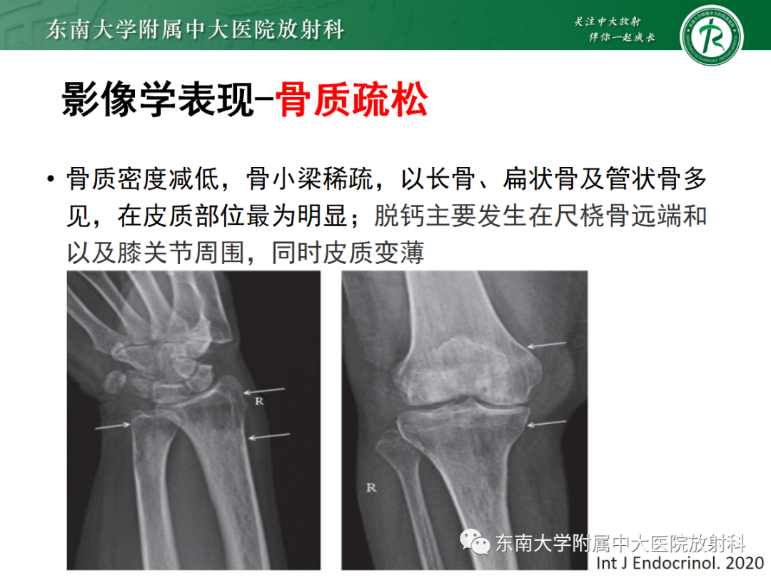 【PPT】原发性甲状旁腺功能亢进-18