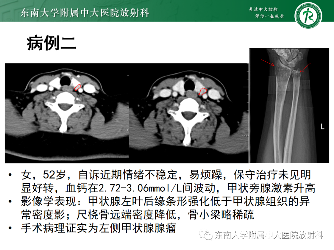 【PPT】原发性甲状旁腺功能亢进-19