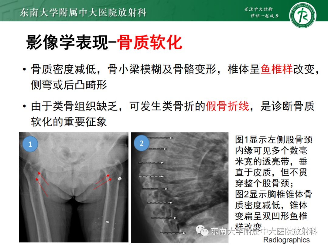 【PPT】原发性甲状旁腺功能亢进-20